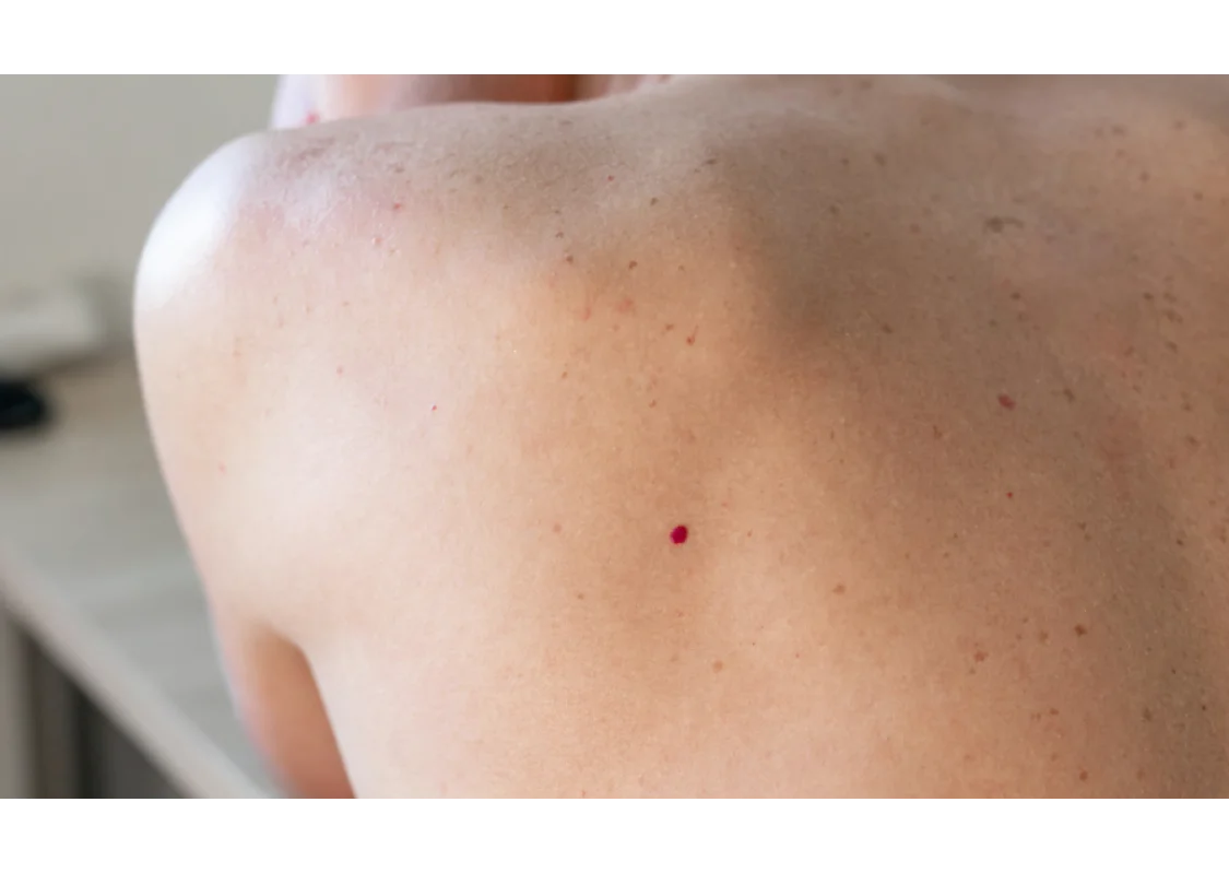 Nei Rossi O Angiomi Rubino Cosa Sono Cause E Rimedi Naturali